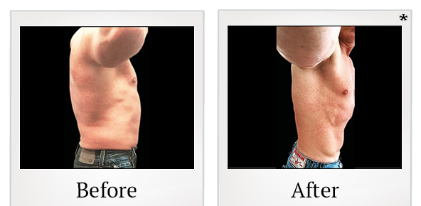 Before and After Photo 31 of Emsculpt® treatment at SF Bay Cosmetic Surgery Medical Group in San Ramon