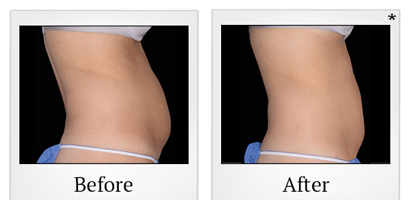 Before and After Photo 32 of Emsculpt® treatment at SF Bay Cosmetic Surgery Medical Group in San Ramon