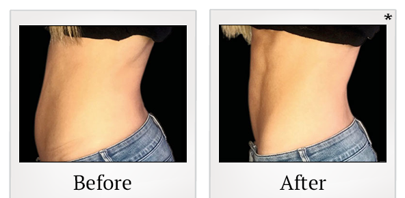 Before and After Photo 33 of Emsculpt® treatment at SF Bay Cosmetic Surgery Medical Group in San Ramon