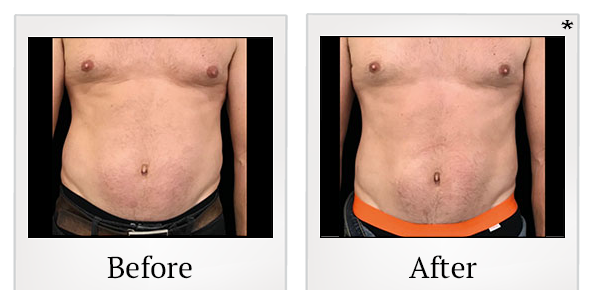Before and After Photo 34 of Emsculpt® treatment at SF Bay Cosmetic Surgery Medical Group in San Ramon