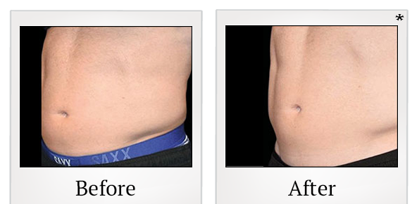 Before and After Photo 35 of Emsculpt® treatment at SF Bay Cosmetic Surgery Medical Group in San Ramon