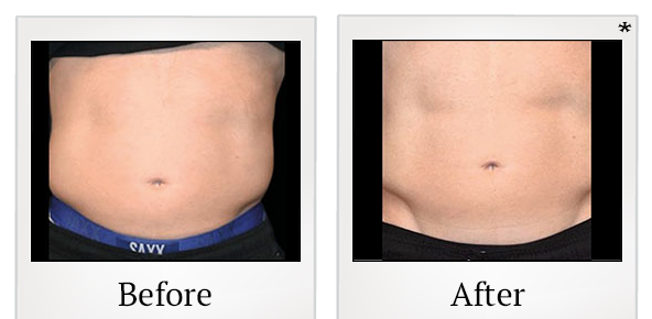 Before and After Photo 36 of Emsculpt® treatment at SF Bay Cosmetic Surgery Medical Group in San Ramon