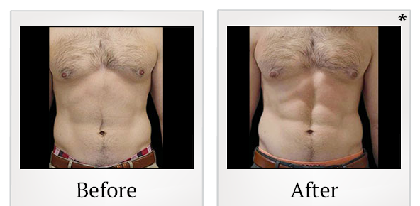 Before and After Photo 37 of Emsculpt® treatment at SF Bay Cosmetic Surgery Medical Group in San Ramon