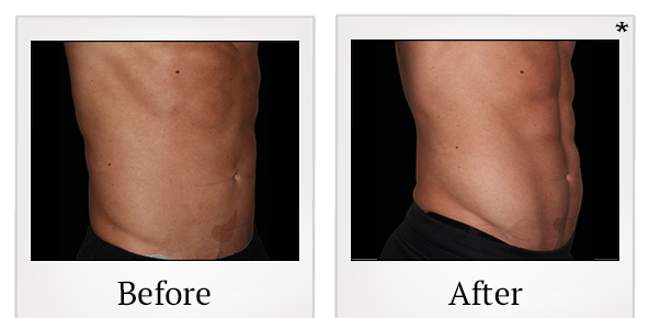 Before and After Photo 38 of Emsculpt® treatment at SF Bay Cosmetic Surgery Medical Group in San Ramon