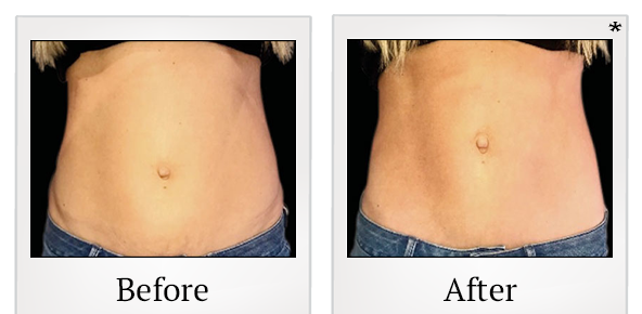 Before and After Photo 39 of Emsculpt® treatment at SF Bay Cosmetic Surgery Medical Group in San Ramon