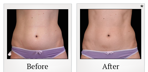 Before and After Photo 4 of Emsculpt® treatment at SF Bay Cosmetic Surgery Medical Group in San Ramon