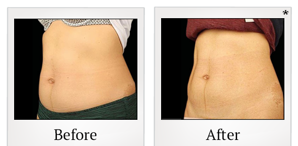 Before and After Photo 40 of Emsculpt® treatment at SF Bay Cosmetic Surgery Medical Group in San Ramon