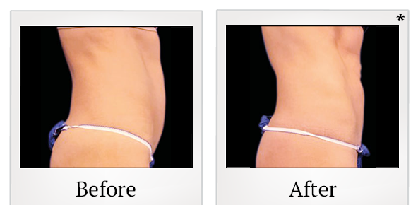Before and After Photo 41 of Emsculpt® treatment at SF Bay Cosmetic Surgery Medical Group in San Ramon