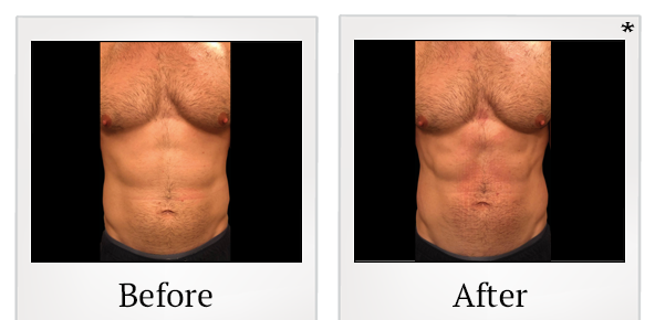 Before and After Photo 42 of Emsculpt® treatment at SF Bay Cosmetic Surgery Medical Group in San Ramon