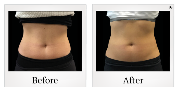 Before and After Photo 43 of Emsculpt® treatment at SF Bay Cosmetic Surgery Medical Group in San Ramon