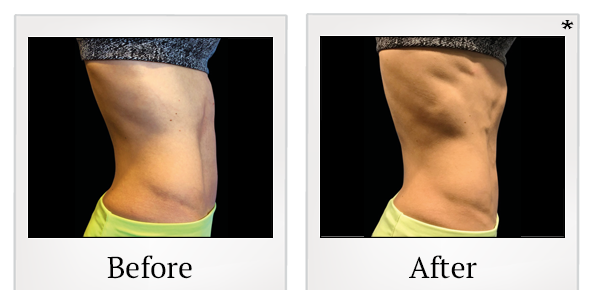 Before and After Photo 44 of Emsculpt® treatment at SF Bay Cosmetic Surgery Medical Group in San Ramon
