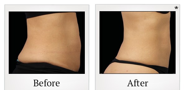 Before and After Photo 45 of Emsculpt® treatment at SF Bay Cosmetic Surgery Medical Group in San Ramon