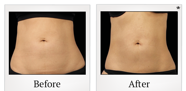 Before and After Photo 46 of Emsculpt® treatment at SF Bay Cosmetic Surgery Medical Group in San Ramon