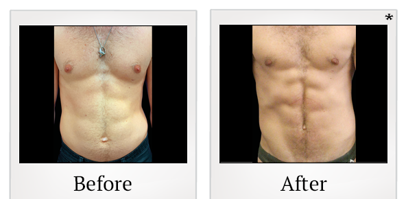 Before and After Photo 47 of Emsculpt® treatment at SF Bay Cosmetic Surgery Medical Group in San Ramon
