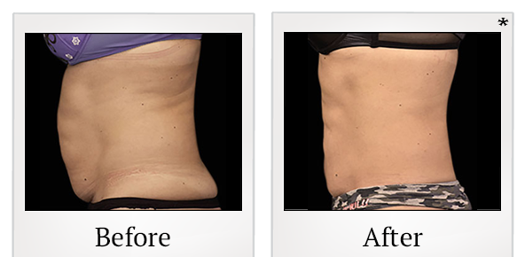 Before and After Photo 48 of Emsculpt® treatment at SF Bay Cosmetic Surgery Medical Group in San Ramon