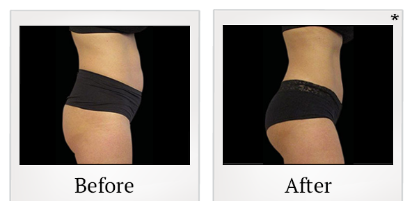 Before and After Photo 49 of Emsculpt® treatment at SF Bay Cosmetic Surgery Medical Group in San Ramon