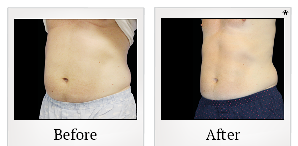 Before and After Photo 5 of Emsculpt® treatment at SF Bay Cosmetic Surgery Medical Group in San Ramon