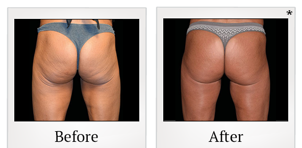 Before and After Photo5 0 of Emsculpt® treatment at SF Bay Cosmetic Surgery Medical Group in San Ramon