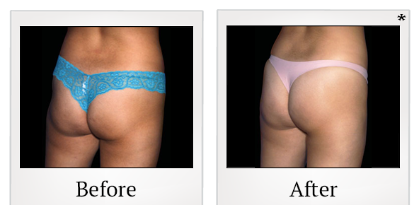 Before and After Photo 51 of Emsculpt® treatment at SF Bay Cosmetic Surgery Medical Group in San Ramon