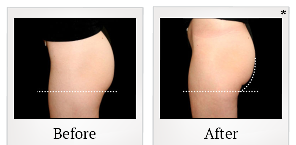 Before and After Photo 52 of Emsculpt® treatment at SF Bay Cosmetic Surgery Medical Group in San Ramon