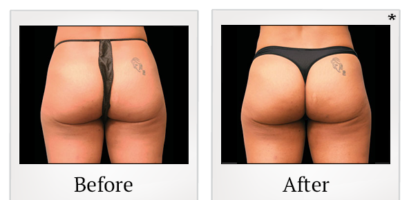 Before and After Photo 53 of Emsculpt® treatment at SF Bay Cosmetic Surgery Medical Group in San Ramon