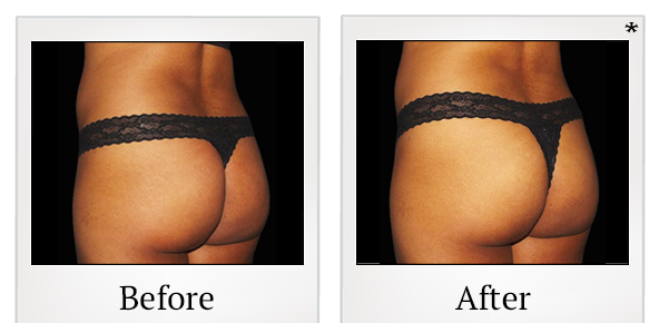 Before and After Photo 54 of Emsculpt® treatment at SF Bay Cosmetic Surgery Medical Group in San Ramon