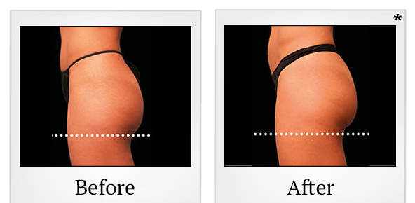 Before and After Photo 55 of Emsculpt® treatment at SF Bay Cosmetic Surgery Medical Group in San Ramon