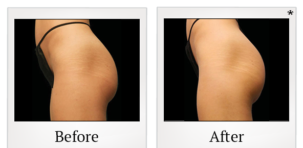 Before and After Photo 56 of Emsculpt® treatment at SF Bay Cosmetic Surgery Medical Group in San Ramon