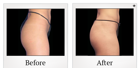 Before and After Photo 57 of Emsculpt® treatment at SF Bay Cosmetic Surgery Medical Group in San Ramon
