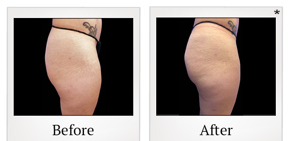 Before and After Photo 58 of Emsculpt® treatment at SF Bay Cosmetic Surgery Medical Group in San Ramon