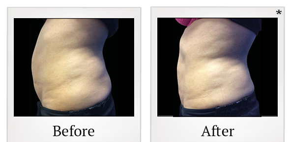 Before and After Photo 6 of Emsculpt® treatment at SF Bay Cosmetic Surgery Medical Group in San Ramon