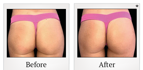 Before and After Photo 60 of Emsculpt® treatment at SF Bay Cosmetic Surgery Medical Group in San Ramon