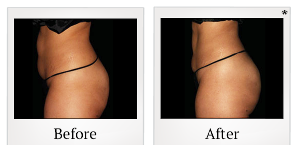 Before and After Photo 61 of Emsculpt® treatment at SF Bay Cosmetic Surgery Medical Group in San Ramon