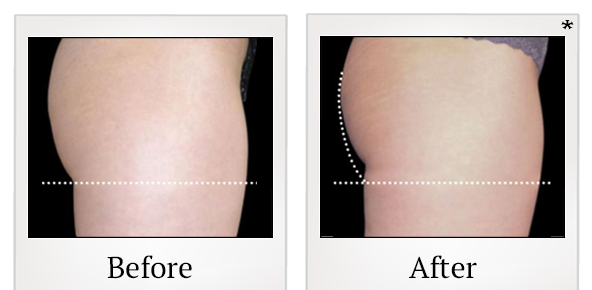 Before and After Photo 62 of Emsculpt® treatment at SF Bay Cosmetic Surgery Medical Group in San Ramon