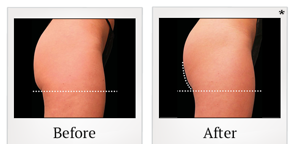 Before and After Photo 63 of Emsculpt® treatment at SF Bay Cosmetic Surgery Medical Group in San Ramon