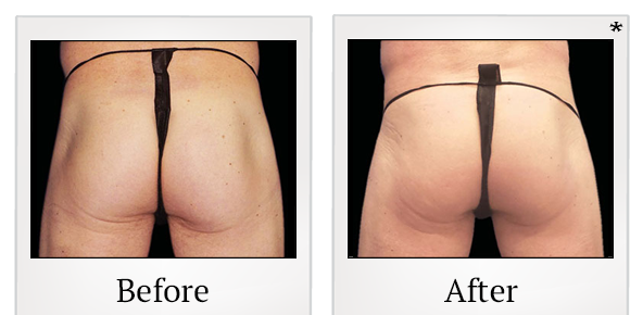 Before and After Photo 64 of Emsculpt® treatment at SF Bay Cosmetic Surgery Medical Group in San Ramon