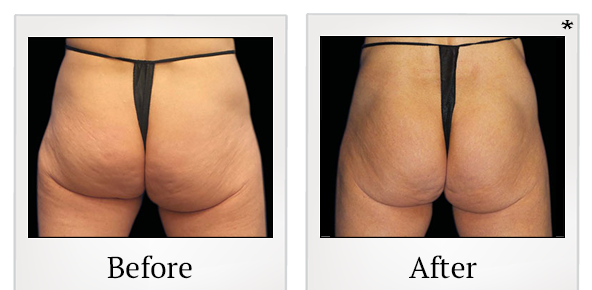 Before and After Photo 65 of Emsculpt® treatment at SF Bay Cosmetic Surgery Medical Group in San Ramon