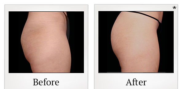 Before and After Photo 66 of Emsculpt® treatment at SF Bay Cosmetic Surgery Medical Group in San Ramon