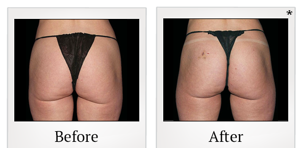 Before and After Photo 67 of Emsculpt® treatment at SF Bay Cosmetic Surgery Medical Group in San Ramon