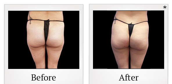 Before and After Photo 68 of Emsculpt® treatment at SF Bay Cosmetic Surgery Medical Group in San Ramon