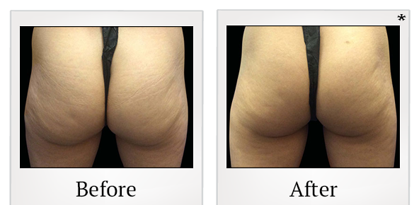 Before and After Photo 69 of Emsculpt® treatment at SF Bay Cosmetic Surgery Medical Group in San Ramon