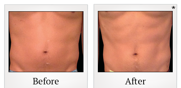 Before and After Photo 7 of Emsculpt® treatment at SF Bay Cosmetic Surgery Medical Group in San Ramon