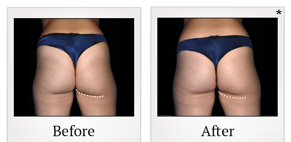 Before and After Photo 70 of Emsculpt® treatment at SF Bay Cosmetic Surgery Medical Group in San Ramon