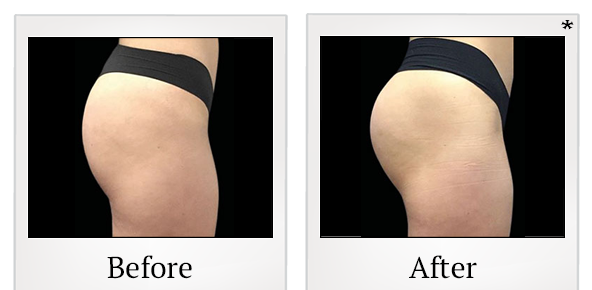 Before and After Photo 71 of Emsculpt® treatment at SF Bay Cosmetic Surgery Medical Group in San Ramon