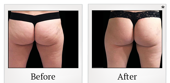 Before and After Photo 72 of Emsculpt® treatment at SF Bay Cosmetic Surgery Medical Group in San Ramon