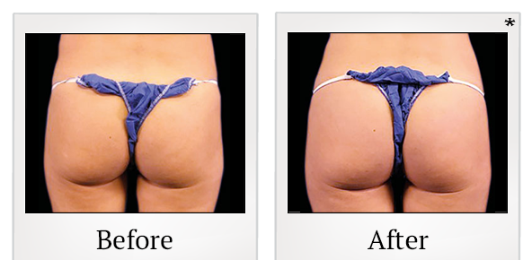Before and After Photo 73 of Emsculpt® treatment at SF Bay Cosmetic Surgery Medical Group in San Ramon
