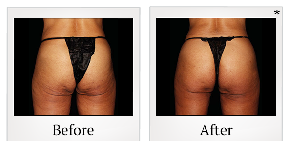 Before and After Photo 74 of Emsculpt® treatment at SF Bay Cosmetic Surgery Medical Group in San Ramon
