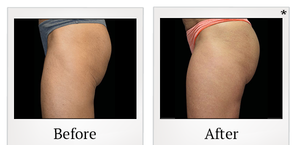 Before and After Photo 75 of Emsculpt® treatment at SF Bay Cosmetic Surgery Medical Group in San Ramon