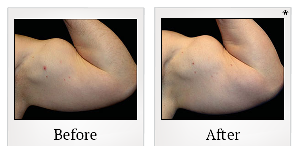 Before and After Photo 76 of Emsculpt® treatment at SF Bay Cosmetic Surgery Medical Group in San Ramon