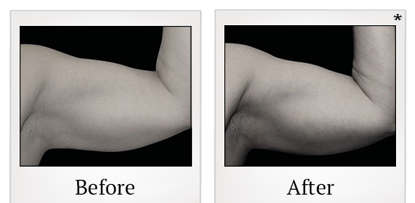 Before and After Photo 77 of Emsculpt® treatment at SF Bay Cosmetic Surgery Medical Group in San Ramon
